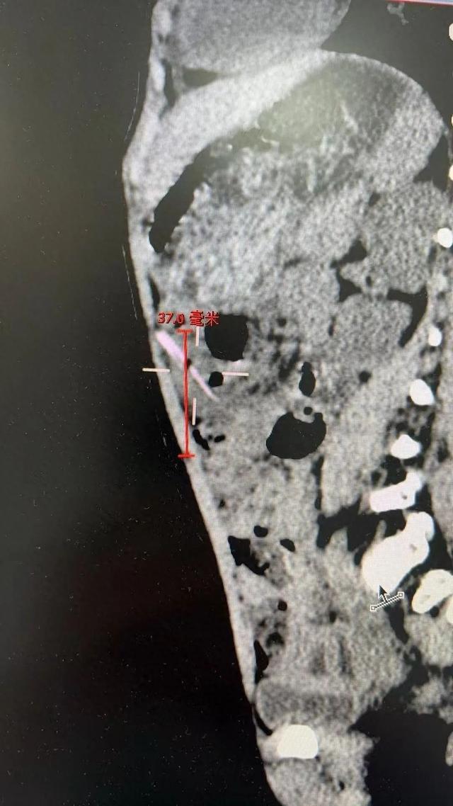 九游娱乐平台：2岁女孩突然腹痛去医院一看令人心惊！不少孩子都有这个习惯(图1)